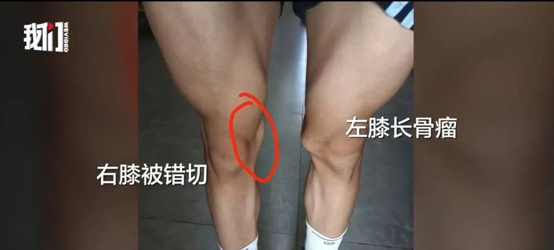 体育生被错切右膝案将开庭，母亲发声：孩子在家里休养近一年，他心里过不去那个坎