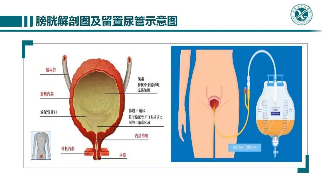 留置导尿患者漏尿原因分析及护理对策