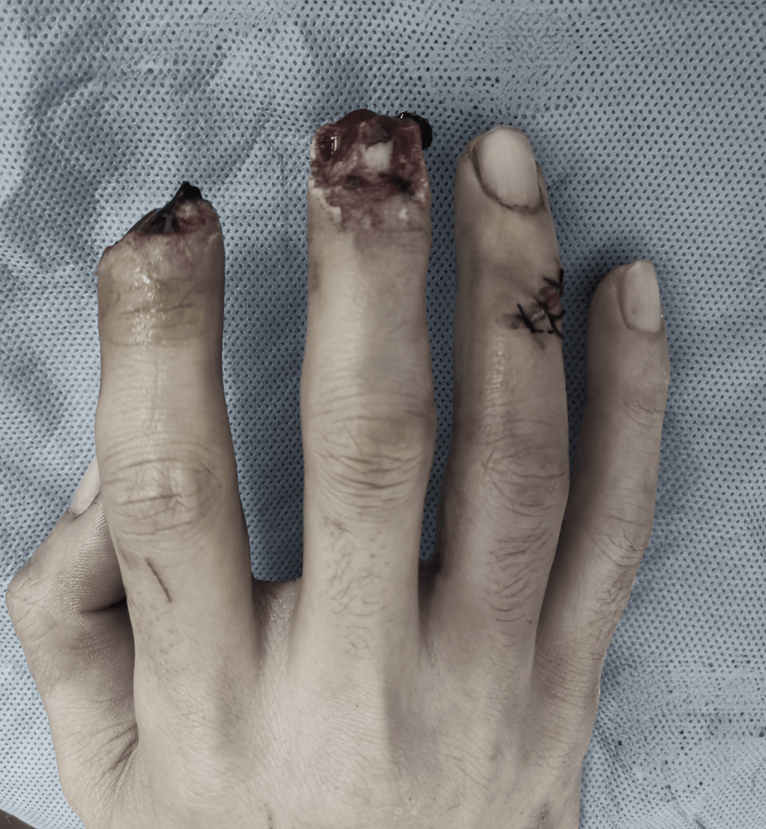 手指缺失十余年 一朝手术满意归!