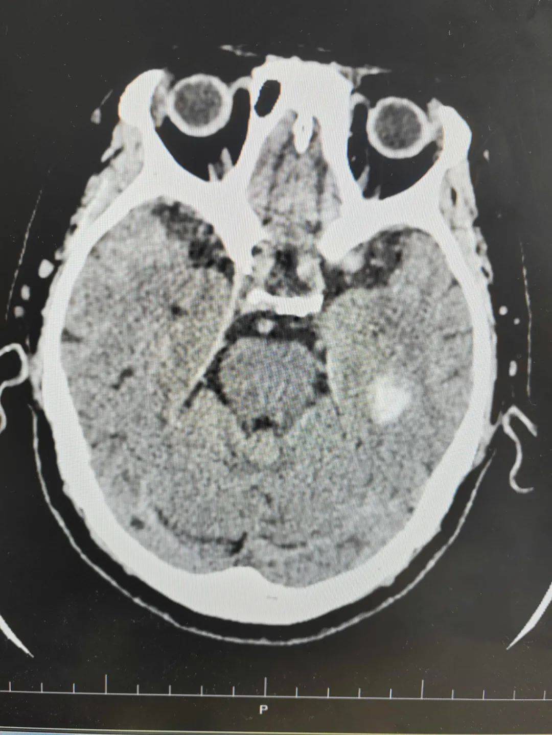健康生活|颅脑ct