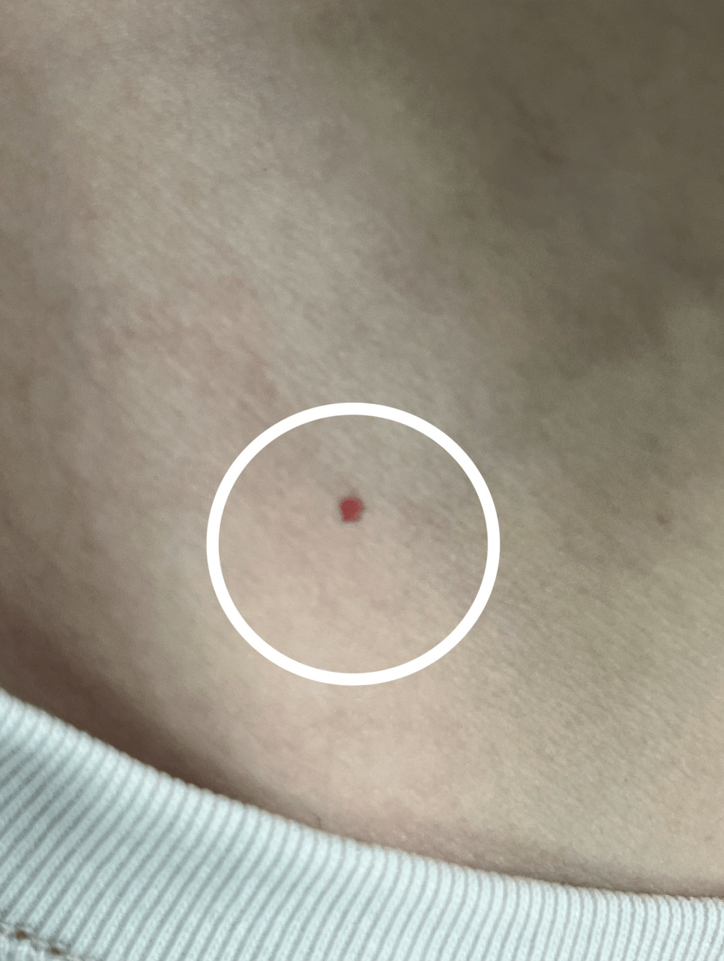 身上突然长的小红点,到底是啥啊,会癌变吗?