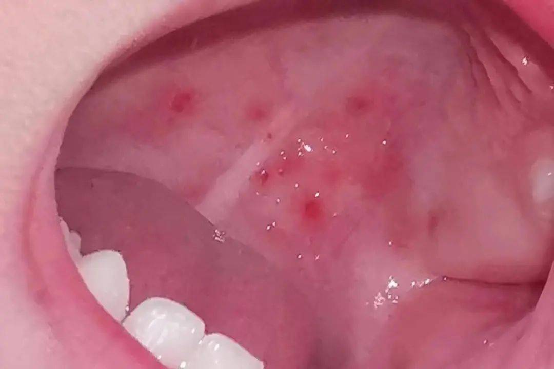 警惕疱疹性咽峡炎!家长必知应对指南