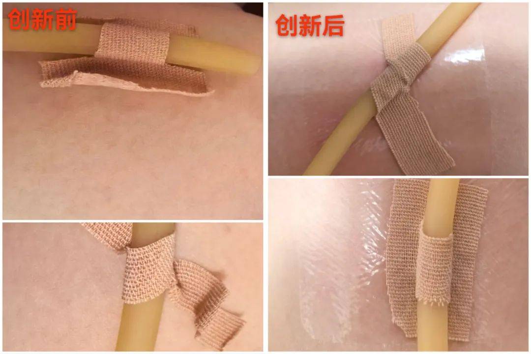 导管脱落总是防不胜防?这种方法可以解决 99% 的胶布卷边!