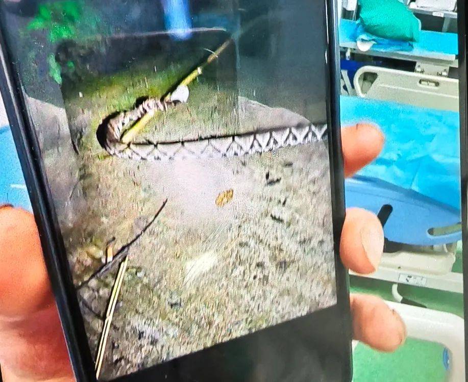 重庆一男子被五步蛇咬伤住进重症监护室!转扩!救命用! 重庆一男子被五步蛇咬伤住进重症监护室!转扩!救命用!