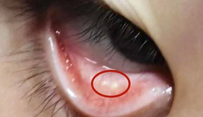 眼睛里有结石是怎么回事儿