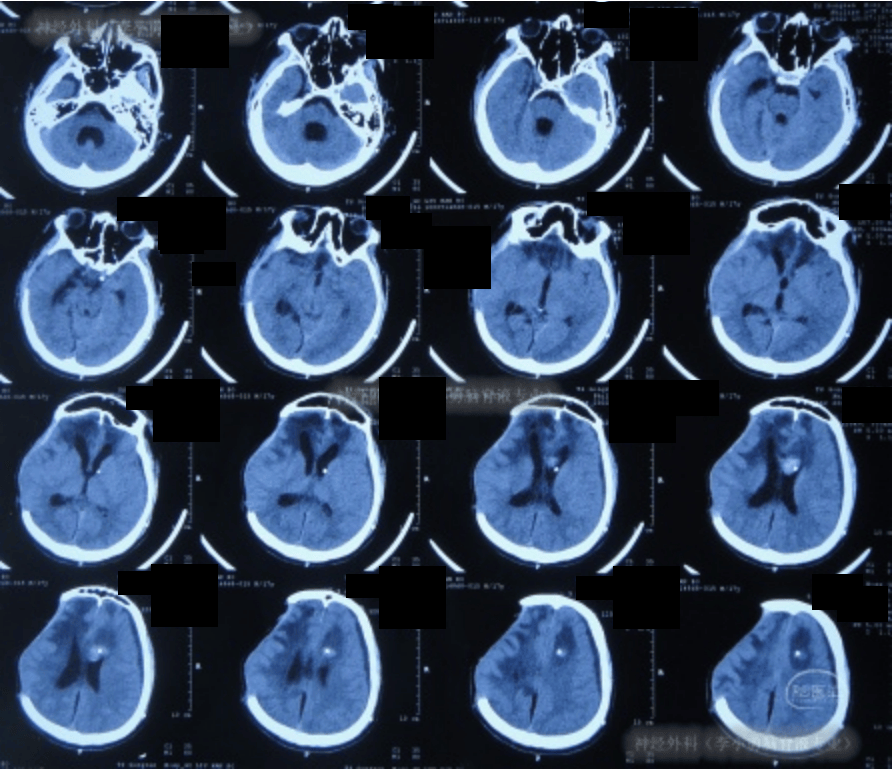 图-9:2022年4月1日头颅ct脑室腹腔分流术后4天即2022年4月1日,查头颅