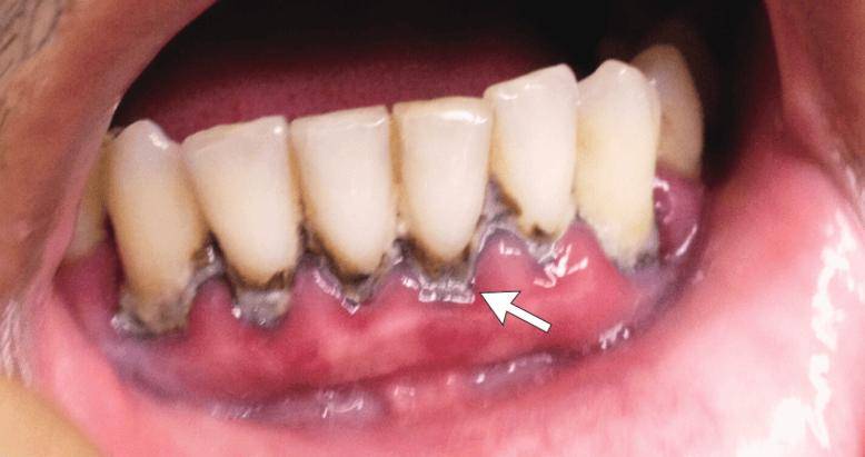 当然除了这种牙齿,牙龈处的黑线,儿童慢性铅中毒后铅会替代牙釉质中的