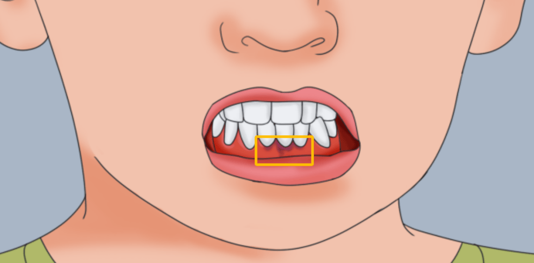 注意| 牙龈边缘上出现深色线条,是铅中毒吗?