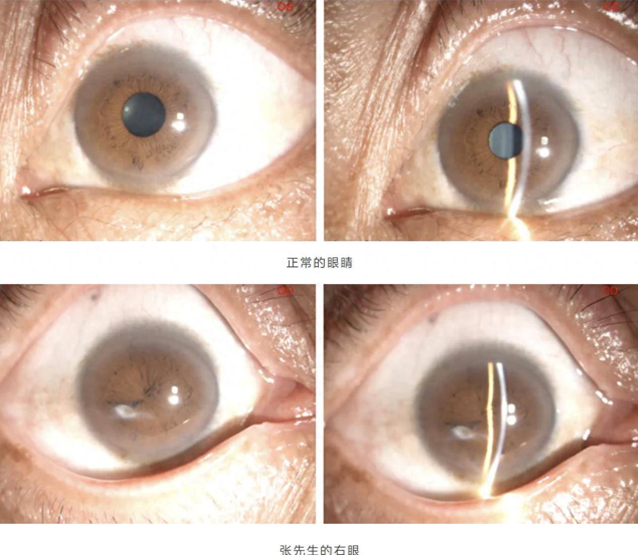 ,角膜中央偏颞下方有片状白色混浊且与虹膜粘连