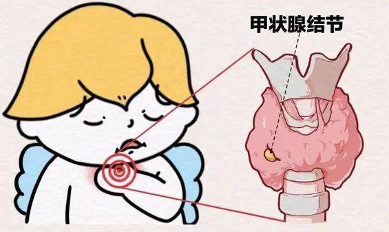 什么是甲状腺结节甲状腺结 节是指在甲状腺内出现的一个或多个结构异常的