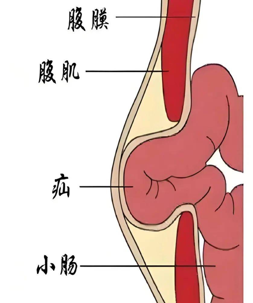全力以"腹"做"疝"事