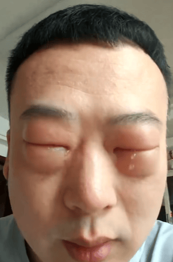 男子吃蚕蛹过敏眼睛肿成“奥特曼”，当事人：人生第一次过敏，吃过蝎子蜈蚣都没事