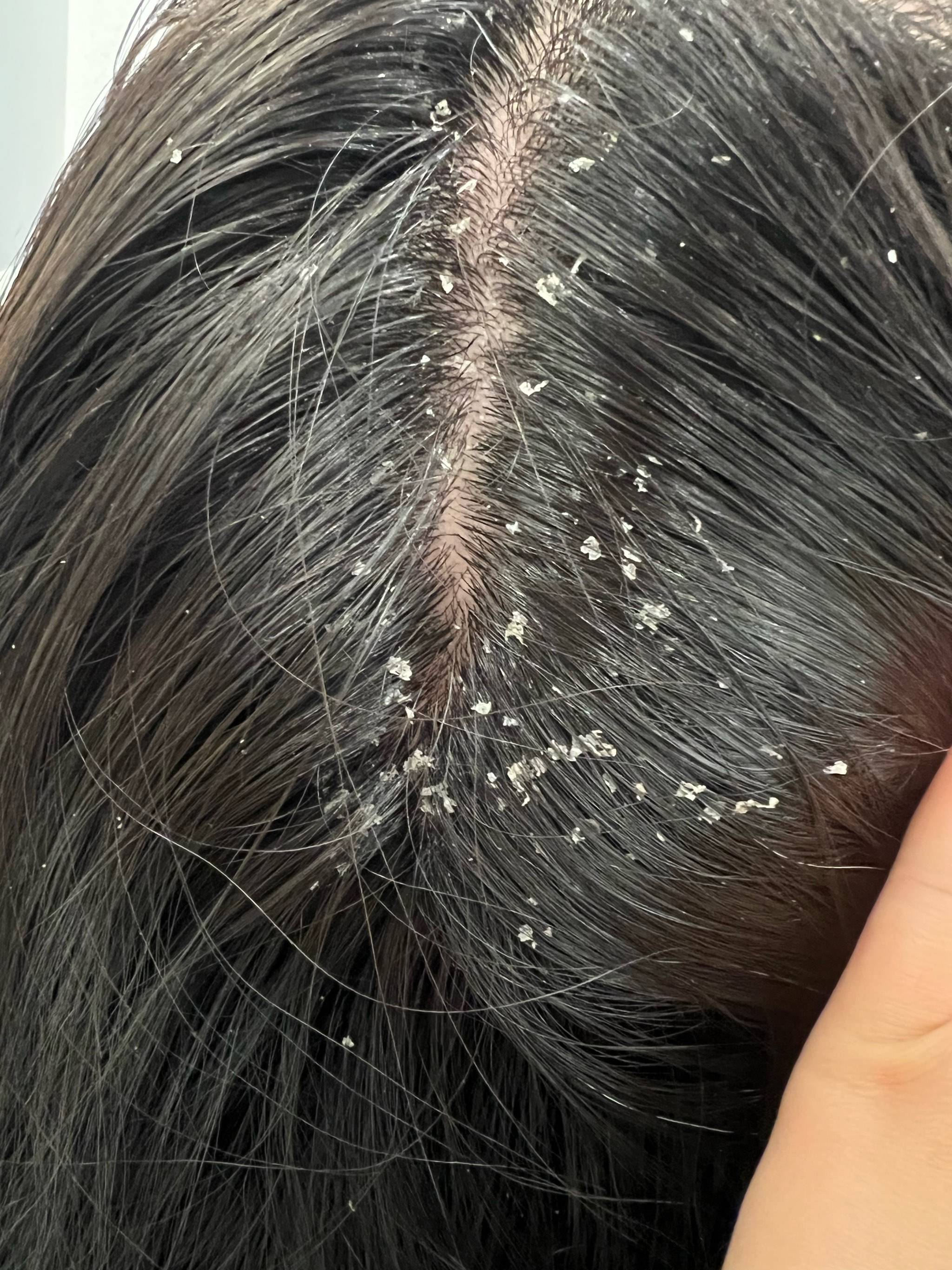 啥牌子的洗发水去屑止痒好?头发蓬松饱满洗发水攻略