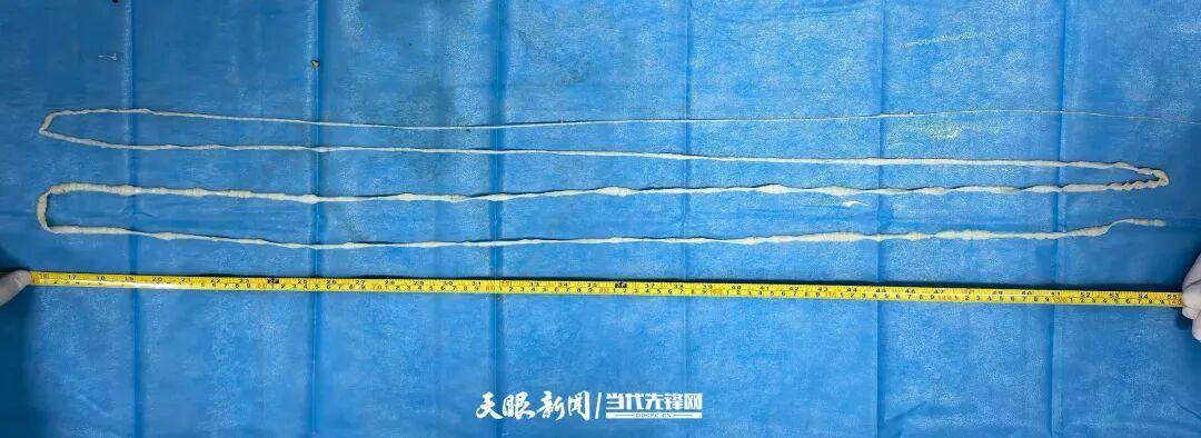 最长4米！贵州一男子连续7个月排出“面条状异物”，医生：很可能和吃这种生食有关