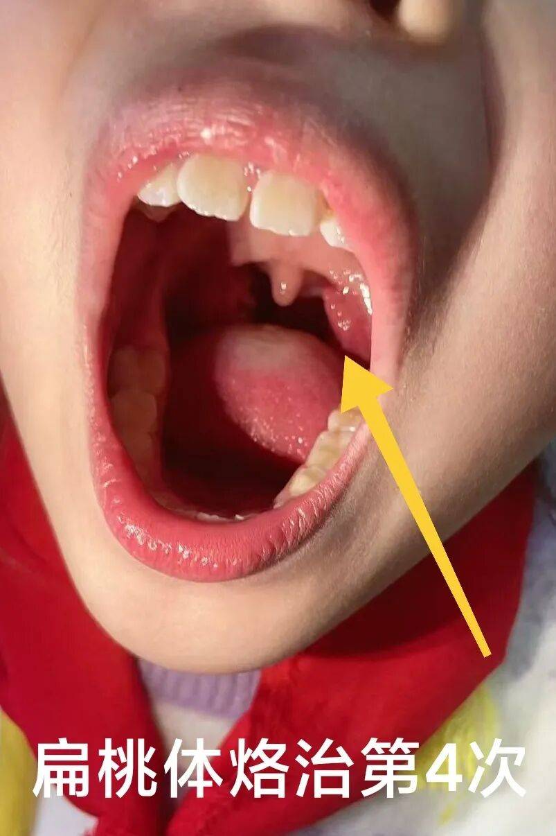 扁桃体总发炎?睡眠打呼噜?中医外治有妙招!