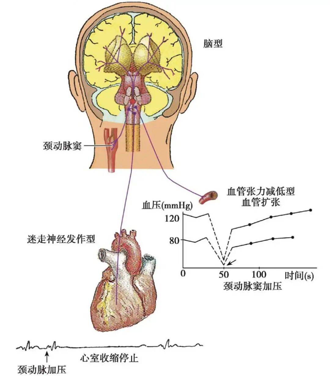 颈动脉窦综合征发生机制|图源：参考资料[3]