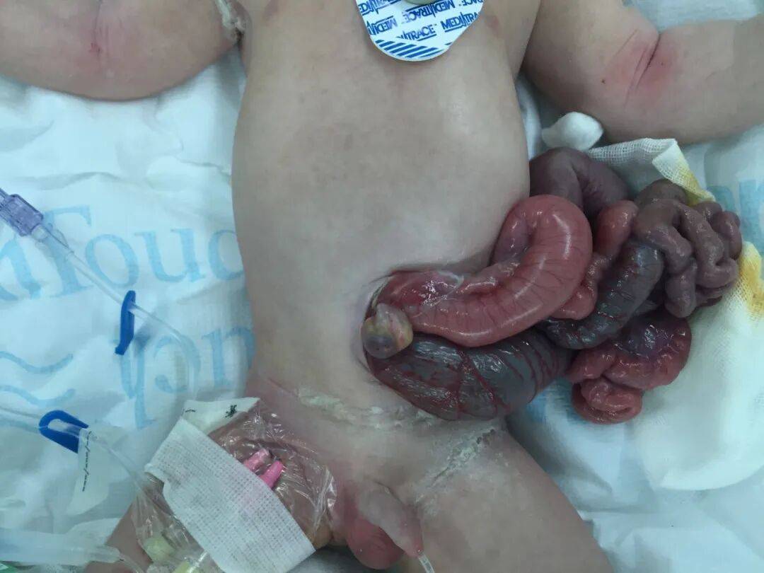 腹裂资料图左右"我们新生儿外科始终秉持不抛弃,不放弃每一个孩子的