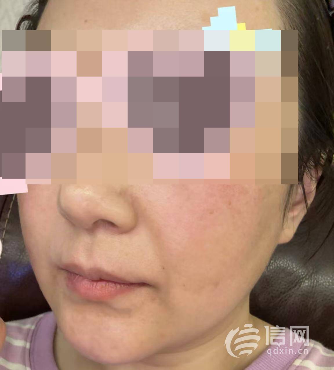 香奈儿柜姐误操作让顾客患上接触性皮炎:该不该清洗没搞明白(图1)