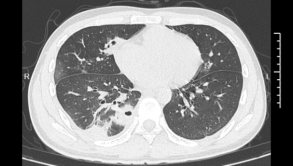 挤了颗痘痘，肺被“啃”出十几个洞！提醒：危险三角区千万别碰！