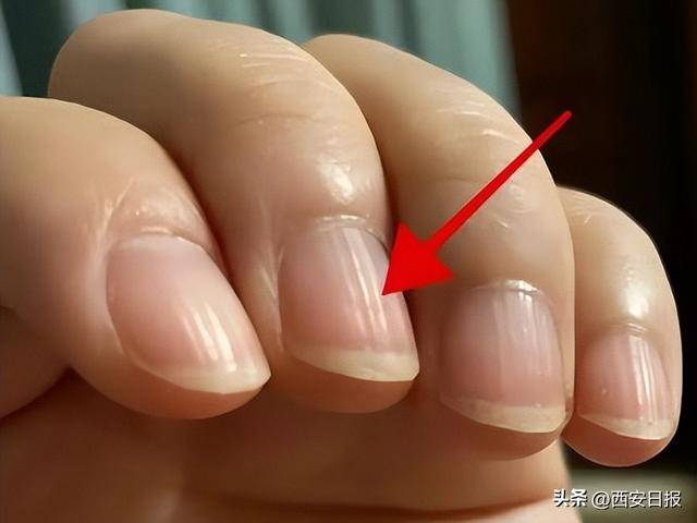 指甲有竖纹是肝不好？易断裂是缺钙？澄清6个指甲传言