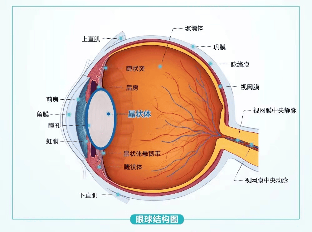 【科普】特发性脉络膜新生血管一文全了解_视力_治疗_视网膜
