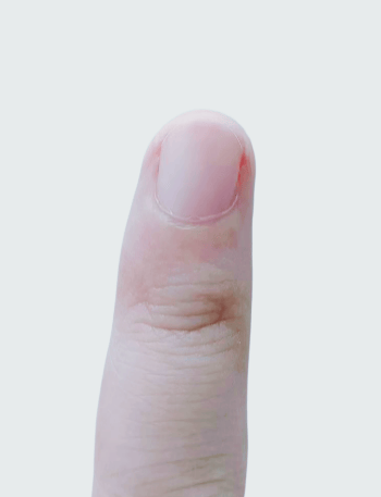 指甲出现这个变化,可能是癌变! 指甲出现这个变化,可能是癌变!