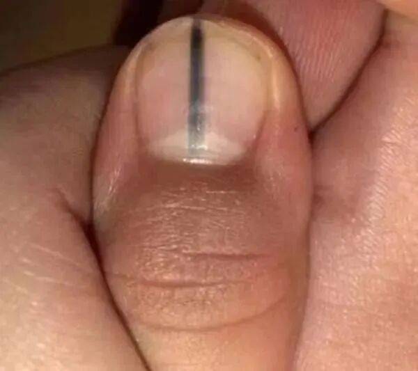 指甲出现这个变化,可能是癌变! 指甲出现这个变化,可能是癌变!