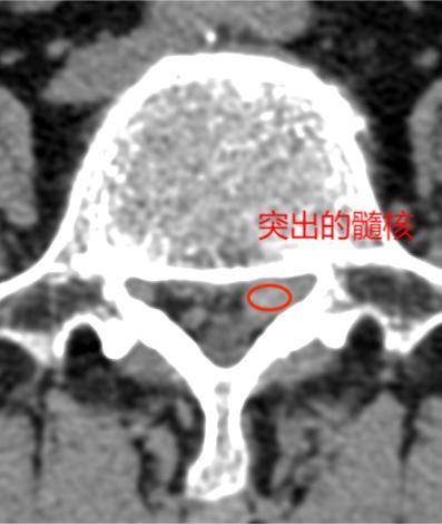 “小切口”解决大困扰 61岁婆婆重获轻松行走