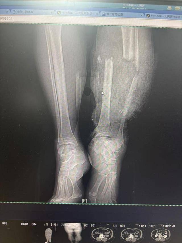 与时间赛跑，为生命护航！多学科协作7小时奋战成功极限保肢