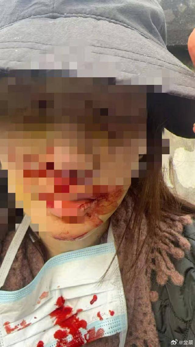金晨公布受伤照：深感惭愧，深刻反省，诚恳致歉