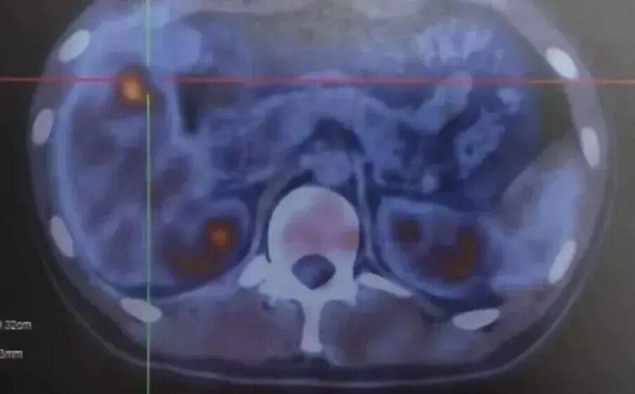 男子查出肠癌，当场崩溃：肠癌早期不是便血，而是这5种异常
