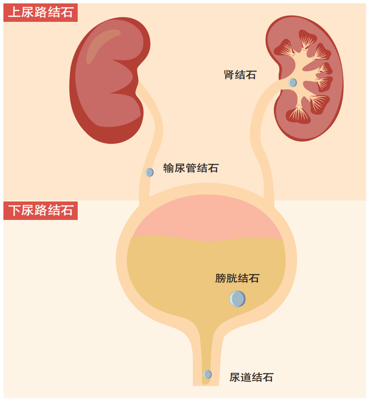夏天结石为何多发？防治要做好4件事，还有这些“偏方”千万不要信！