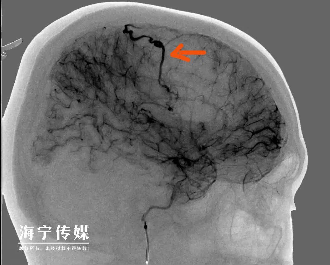 “年纪轻轻，不沾烟酒，就偏瘫？”23岁小伙上班时突然昏倒，原因竟是……