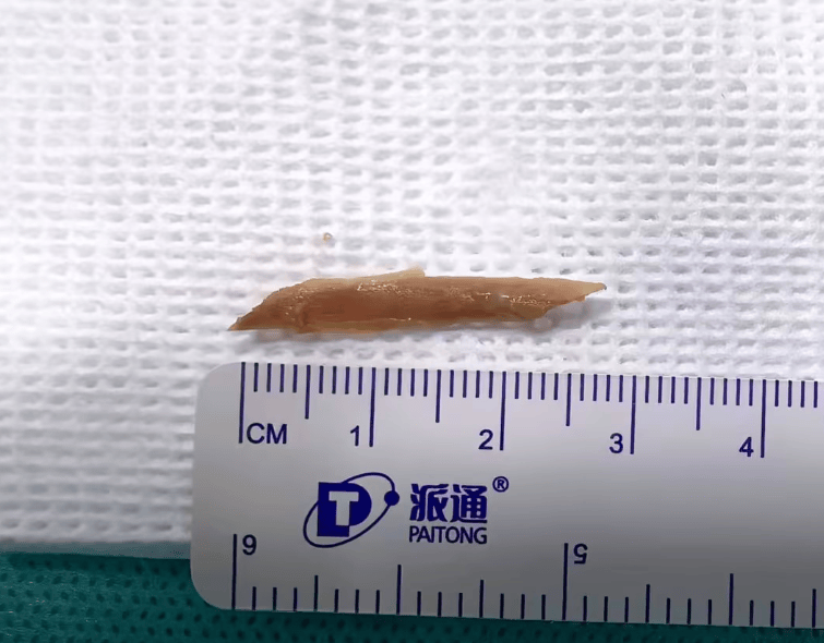 女子不小心吞下一块鸡骨，她大口吞咽饭团，没想到加重了伤情，医生：这是“定时炸弹”